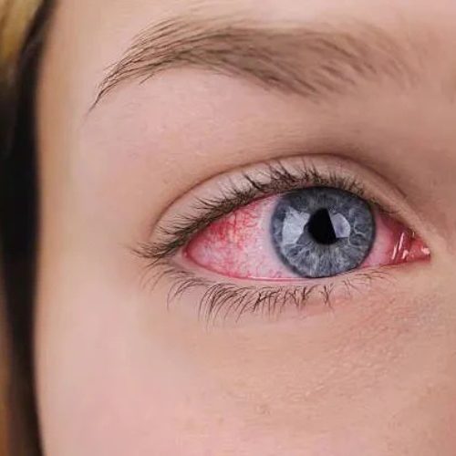 Eye Allergies